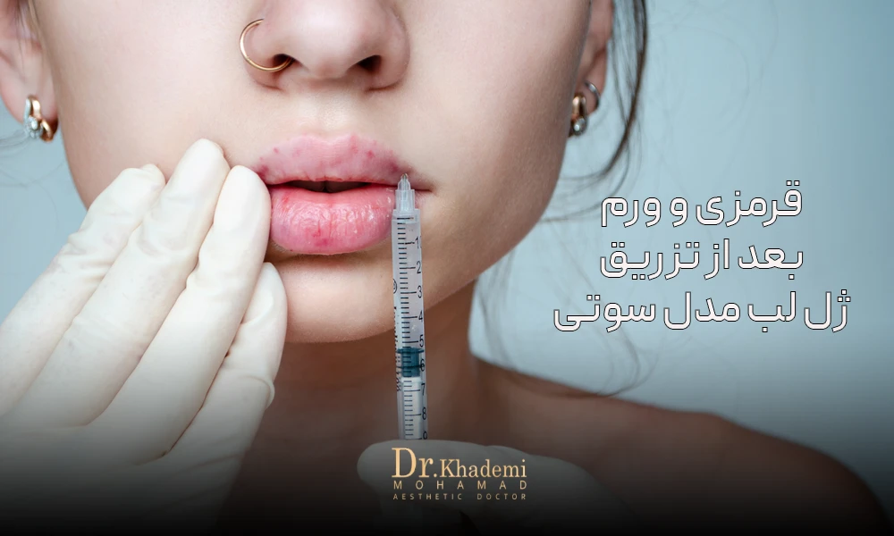 عکس لبی است مه بعد از تزریق کبود شده