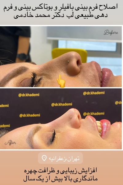 قبل و بعد تزریق فیلر بینی