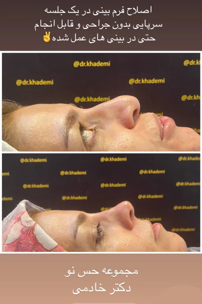 اصلاح بینی یک خانوم توسط دکتر محمد خادمی