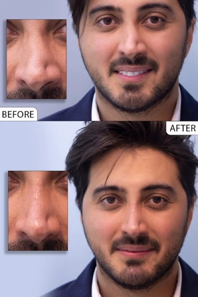 قبل و بعد تزریق فیلر بینی استخوانی