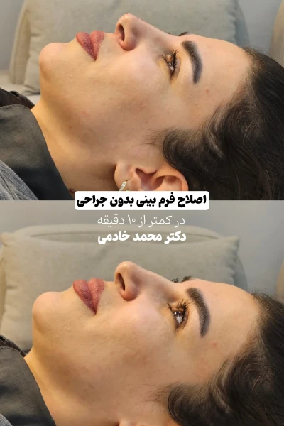 قبل و بعد بینی یک خانم بعد از تزریق فیلر بینی