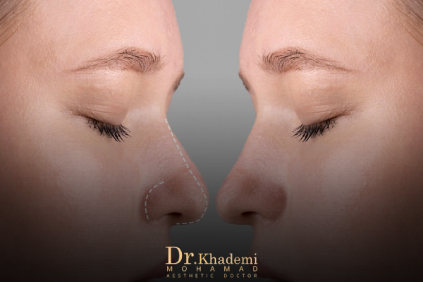 عمل بینی بعد از تزریق فیلر بینی