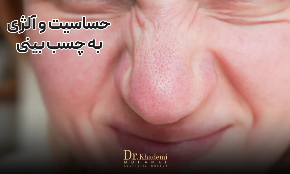 در اثر حساسیت به چسب بینی پوست بینی قرمز شده است.