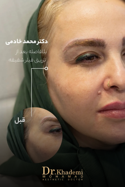 عکس از تزریق ژل شقیقه