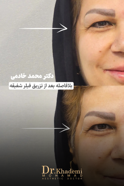 تصویر قبل و بعد از تزریق ژل شقیقه