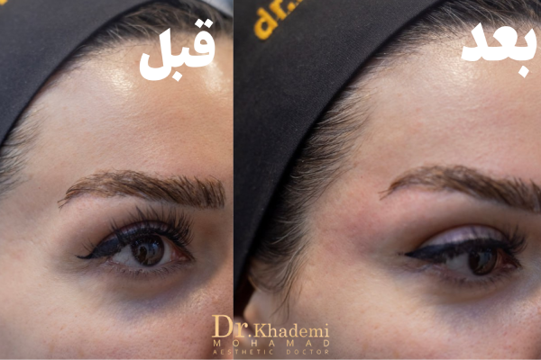 نحوه تزریق ژل شقیقه