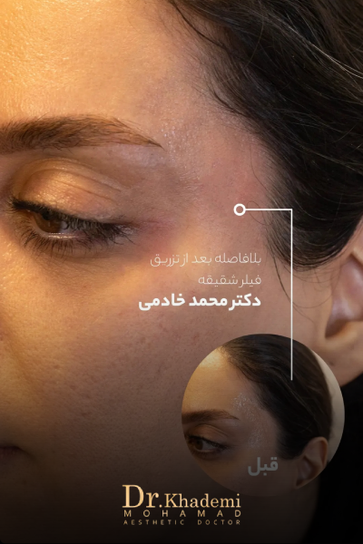 تصویر از فردی که تزریق ژل شقثقه انجام داده