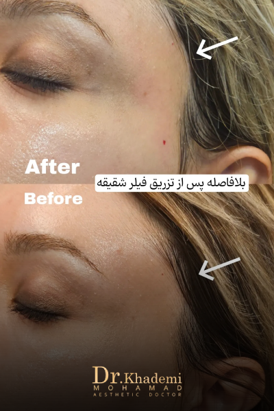 عکس قبل و بعد از تزریق ژل شقیقه