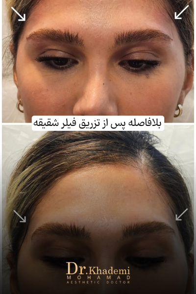 نمونه عکس از تزریق فیلر شقیقه