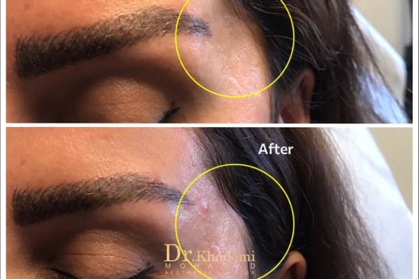 تصویر قبل و بعد تزریق فیلر شقیقه