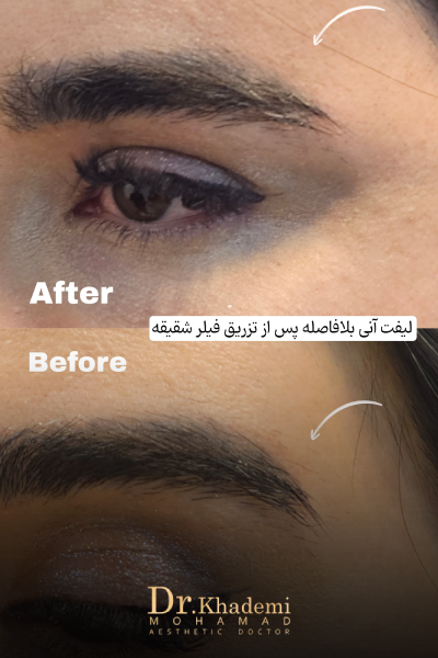 تزریق ژل شقیقه